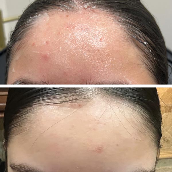 before and after acne treatment